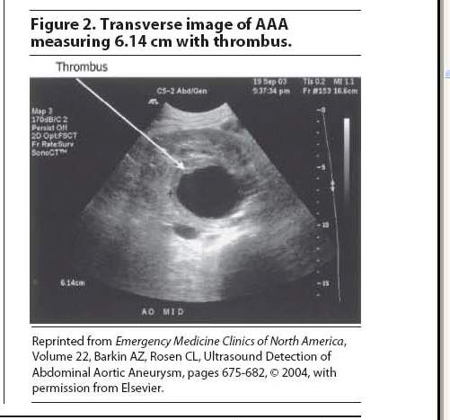 Figure 2. Transverse image of AAA measuring 6.14 cm with thrombus